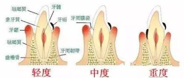牙齦萎縮的各種情況 牙齦萎縮的各種情況