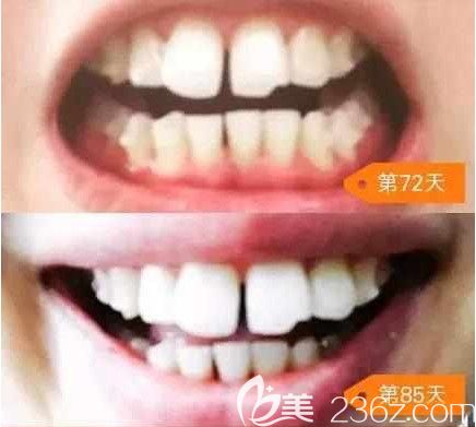 剛帶隱適美牙套72天和第85天的照片 剛帶隱適美牙套72天和第85天的照片