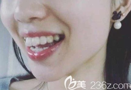 戴第12副牙套的留照 戴第12副牙套的留照