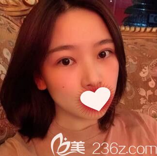 長(zhǎng)沙亞韓誰(shuí)做的雙眼皮好？看我找鄭京湘做的韓式切開雙眼皮+開眼角術(shù)后50天恢復(fù)效果怎么樣？