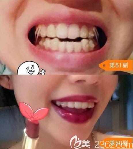 第51和58副牙套正在進(jìn)行微調(diào) 第51和58副牙套正在進(jìn)行微調(diào)