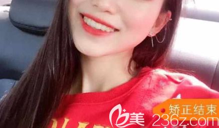 想了解湛江牙齒矯正哪家醫(yī)院好的親們,可看我在湛江致美口腔做隱適美齙牙矯正的效果及點(diǎn)評(píng)!