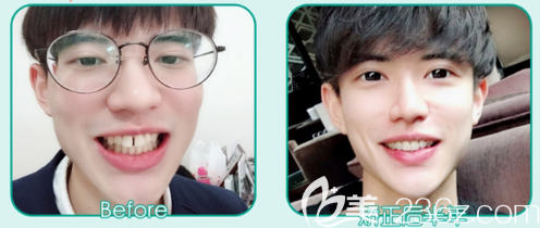 廣州藝美袁媛主任半透明陶瓷托槽牙齒矯正案例