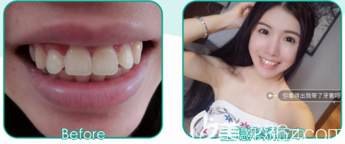 廣州藝袁媛做的全透明隱形牙齒矯正案例對比圖