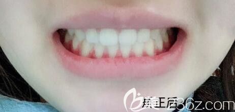 31歲走上正畸路,評價下我在武漢德韓口腔做半隱形陶瓷托槽牙齒矯正的效果好不好