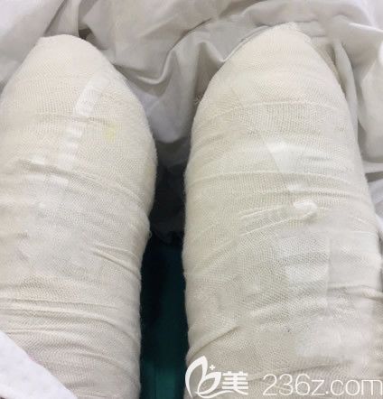 蘭州仁和整形<!--<i data=20240703-sp></i>-->大腿抽脂第1天 蘭州仁和整形<!--<i data=20240703-sp></i>-->大腿抽脂第1天