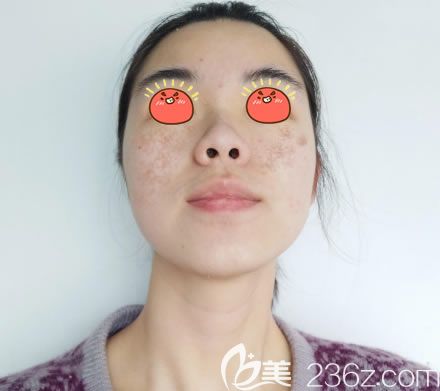 在紹興維美醫(yī)院做激光祛斑前 在紹興維美醫(yī)院做激光祛斑前