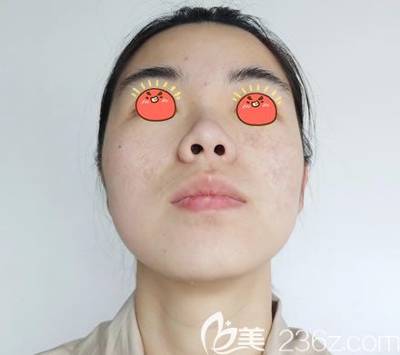 皮秒激光祛斑11天恢復效果圖 皮秒激光祛斑11天恢復效果圖