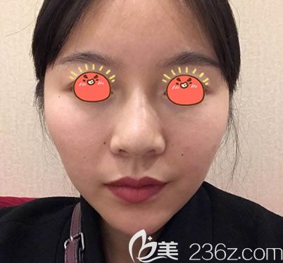 在金華亞美做自體脂肪填充前 在金華亞美做自體脂肪填充前