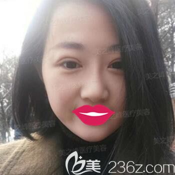 做TWO-DAYS雙眼皮術(shù)后10天恢復(fù)效果