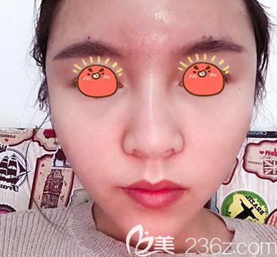 剛做完自體脂肪填充全臉的圖片 剛做完自體脂肪填充全臉的圖片