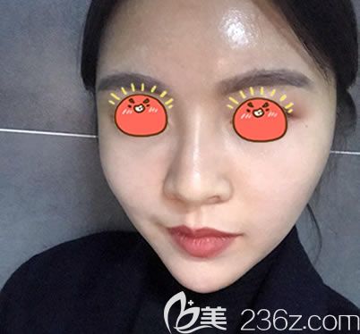 自體脂肪填充全臉15天恢復(fù)照 自體脂肪填充全臉15天恢復(fù)照