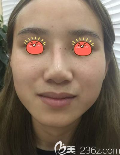 做隆鼻失敗假體歪斜的照片 做隆鼻失敗假體歪斜的照片