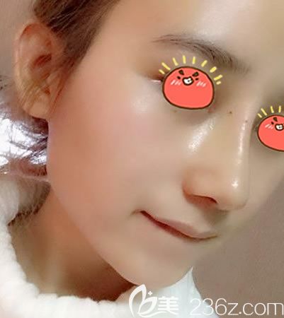 金華瑞麗整形鼻修復(fù)案例9天效果 金華瑞麗整形鼻修復(fù)案例9天效果