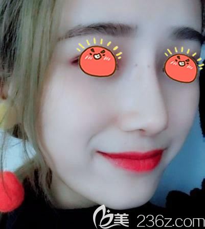 二次做隆鼻經(jīng)歷,金華瑞麗鼻綜合修復手術結束我做隆鼻失敗的噩夢!!!