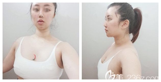 術(shù)前面診南通維多利亞胸部較小 術(shù)前面診南通維多利亞胸部較小