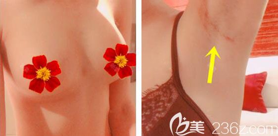 韓國(guó)芭堂韓承范蓓菈假體隆胸術(shù)后1月效果與疤痕恢復(fù)圖 韓國(guó)芭堂韓承范蓓菈假體隆胸術(shù)后1月效果與疤痕恢復(fù)圖