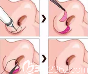 鼻翼縮小手術(shù)過程 鼻翼縮小手術(shù)過程