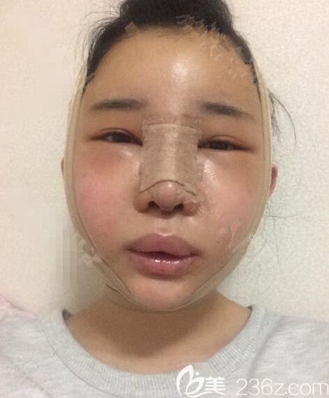 手術(shù)當天 手術(shù)當天