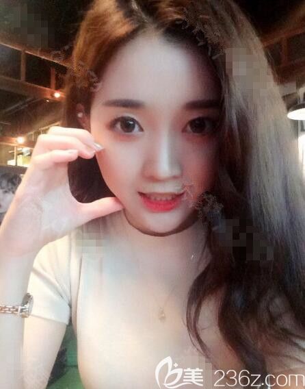 有勇敢一次在韓國(guó)德萊茵整形做了鼻修復(fù)，顴骨縮小脂肪填充1年后氣質(zhì)大不同