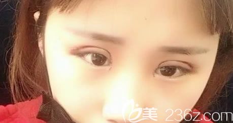 做完全切雙眼皮4天后疤痕情況