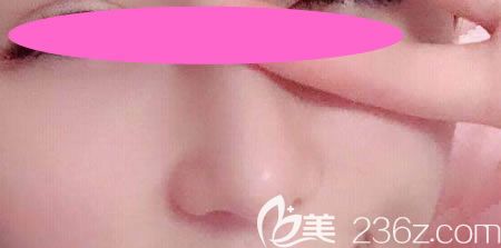 花9800元找景德鎮(zhèn)藝美虞國鋒做假體+半肋骨隆鼻術(shù)后第36天恢復(fù)效果 花9800元找景德鎮(zhèn)藝美虞國鋒做假體+半肋骨隆鼻術(shù)后第36天恢復(fù)效果