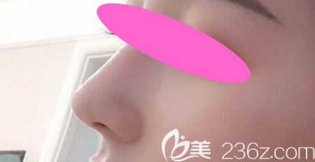 公開我花9800元找景德鎮(zhèn)藝美虞國鋒做假體+半肋骨隆鼻術后60天恢復過程及效果圖