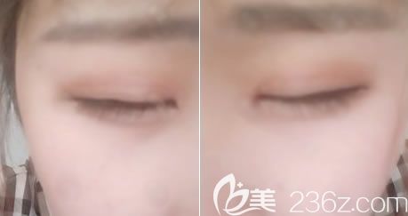 做全切雙眼皮15天疤痕恢復照片