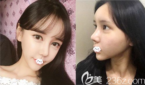 韓國DI醫(yī)院假體隆鼻失敗修復+脂肪面部填充恢復圖