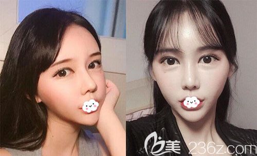 韓國DI整形醫(yī)院鼻修復+自體脂肪面部填充術后1個月效果圖