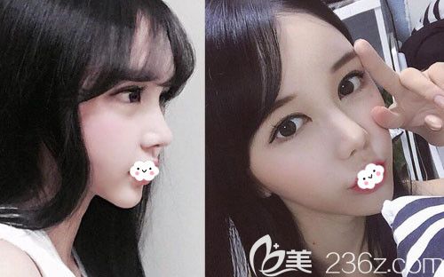 鼻整形失敗到韓國DI整形醫(yī)院做假體隆鼻+鼻尖鼻中隔軟骨修復(fù)及全臉脂肪填充案例恢復(fù)圖