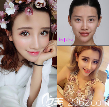 煙臺(tái)鵬愛(ài)醫(yī)院隆鼻的照片