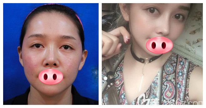合肥維多利亞衛(wèi)愛俠手術(shù)怎么樣？衛(wèi)院長鼻綜合隆鼻案例效果驗(yàn)證