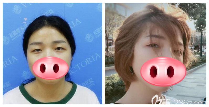 徐和林院長擅長做什么？來看維多利亞徐和林院長眼綜合案例前后對比效果