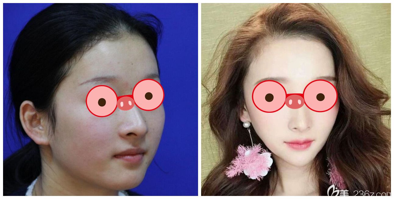 合肥維多利亞張靜瘦臉案例前后效果對比照片