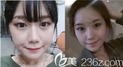 必嫵整形醫(yī)院尹昶云輪廓真人案例 必嫵整形醫(yī)院尹昶云輪廓真人案例