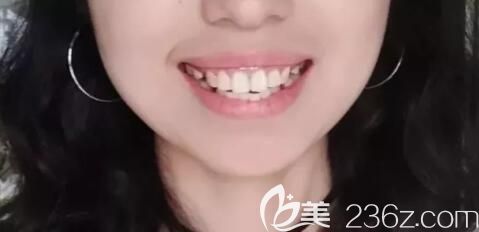 威海舒好口腔牙齒矯正前照 威海舒好口腔牙齒矯正前照