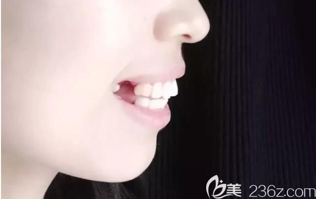 矯正前拔牙后照片 矯正前拔牙后照片