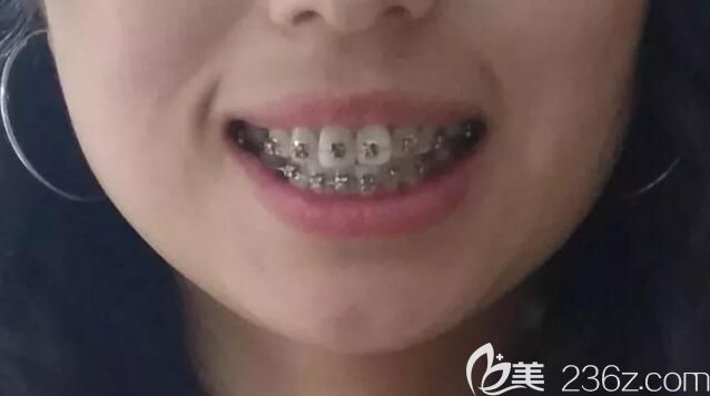 劉炳黎院長(zhǎng)牙齒矯正案例中初戴牙套的照片 劉炳黎院長(zhǎng)牙齒矯正案例中初戴牙套的照片