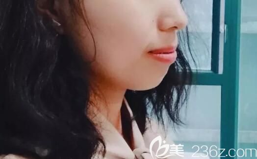 在威海舒好口腔做齙牙矯正中側(cè)面樣子 在威海舒好口腔做齙牙矯正中側(cè)面樣子