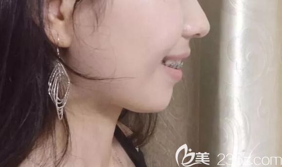 威海正畸哪里好？分享下我找威海舒好口腔劉炳黎院長做二次矯正1年來的臉型變化圖