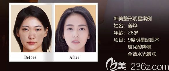 天水韓美整形董彭濤9度明星媚眼術(shù)+玻尿酸隆鼻+水光嫩膚圖