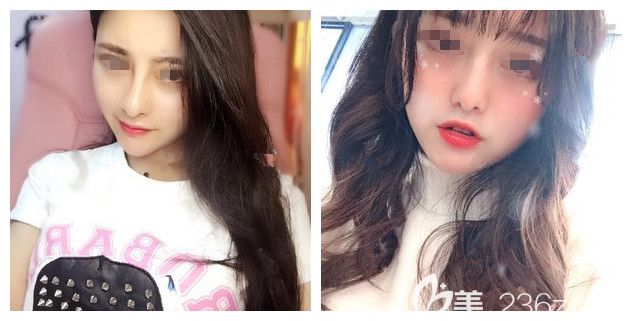 顯兇的鷹鉤鼻到南通維多利亞做了合資艷冠1段硅膠鼻假體術(shù)后1個(gè)月就輕松改善了