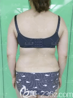 在北京上上相找侯月華醫(yī)生做腰腹環(huán)吸前后面樣子 在北京上上相找侯月華醫(yī)生做腰腹環(huán)吸前后面樣子