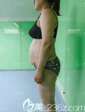 在北京上上相做腰腹吸脂前側(cè)面樣子 在北京上上相做腰腹吸脂前側(cè)面樣子