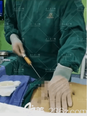 侯月華醫(yī)生給我做腰腹吸脂當(dāng)天手術(shù)照 侯月華醫(yī)生給我做腰腹吸脂當(dāng)天手術(shù)照