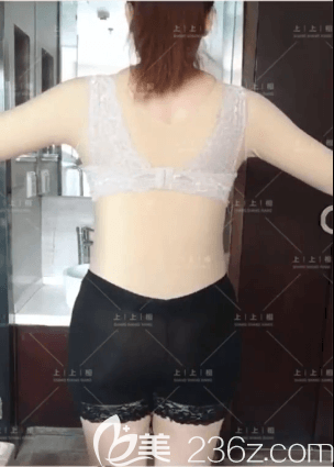 北京上上相醫(yī)療美容腰腹吸脂案例 北京上上相醫(yī)療美容腰腹吸脂案例