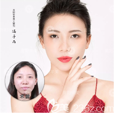 貴陽(yáng)華美玻尿酸填充面部