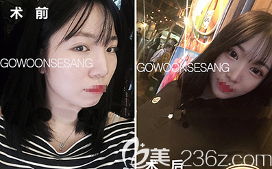 韓國李炳澮院長鷹鉤鼻矯正案例前后效果對比圖