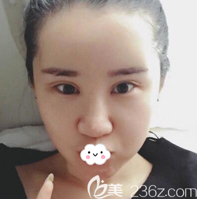 成都艾米麗脂肪填充術(shù)后4天恢復(fù)效果 成都艾米麗脂肪填充術(shù)后4天恢復(fù)效果